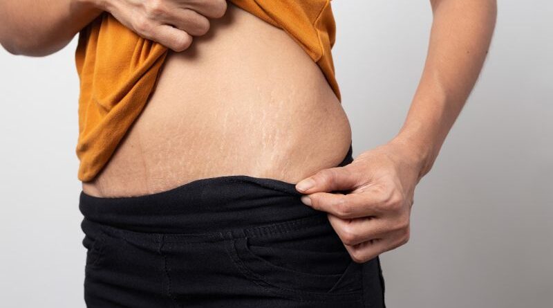 How to get rid of stretch marks
