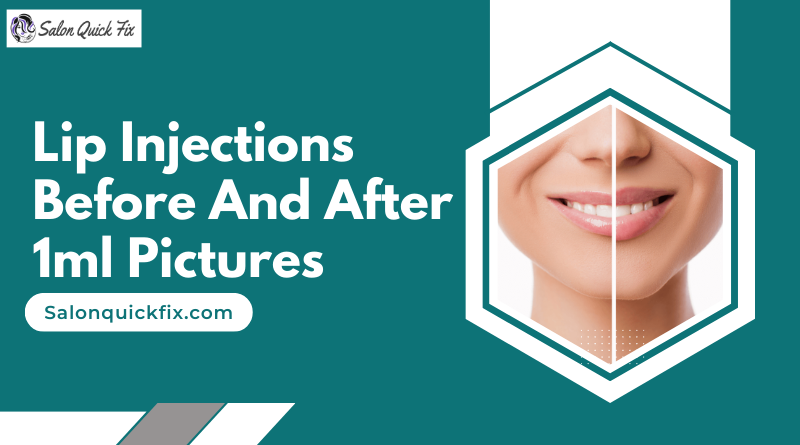 Lip Injections Before And After 1ml Pictures